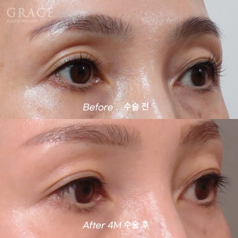 In Your 50s, Restoring a Youthful Look with Before-and-After Eye Surgery and Fat Grafting to the Upper Eyelids, Temples, Under-Eyes, and Above the Brows image 11