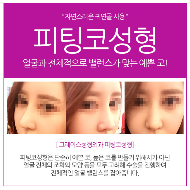 #자유자재로 움직인다! 그레이스성형외과의 혁신, 피팅코성형 관련 이미지 2