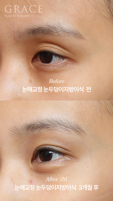 눈두덩이지방이식 붓기 언제 빠질까? 부작용&middot;유지기간까지 1주&middot;3개월&middot;6개월 변화 관련 이미지 3