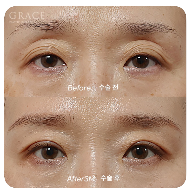 Causes of Sunken Eyelids and How Eyelid Fat Grafting Can Change Your Impression image 6
