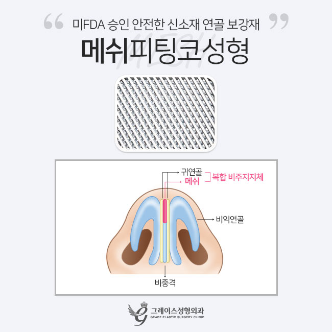 메쉬코성형 자연스러움과 오똑함을 동시에! 관련 이미지 3
