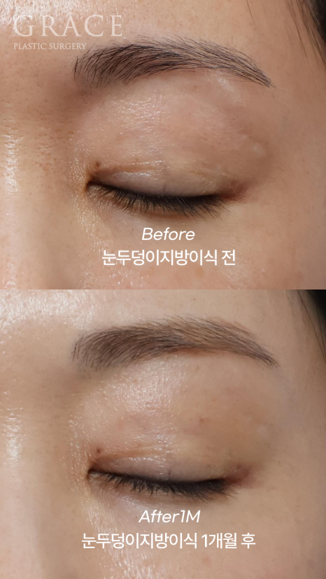 How Long Does Upper Eyelid Fat Grafting Last? The Facts About Maintenance Period image 5