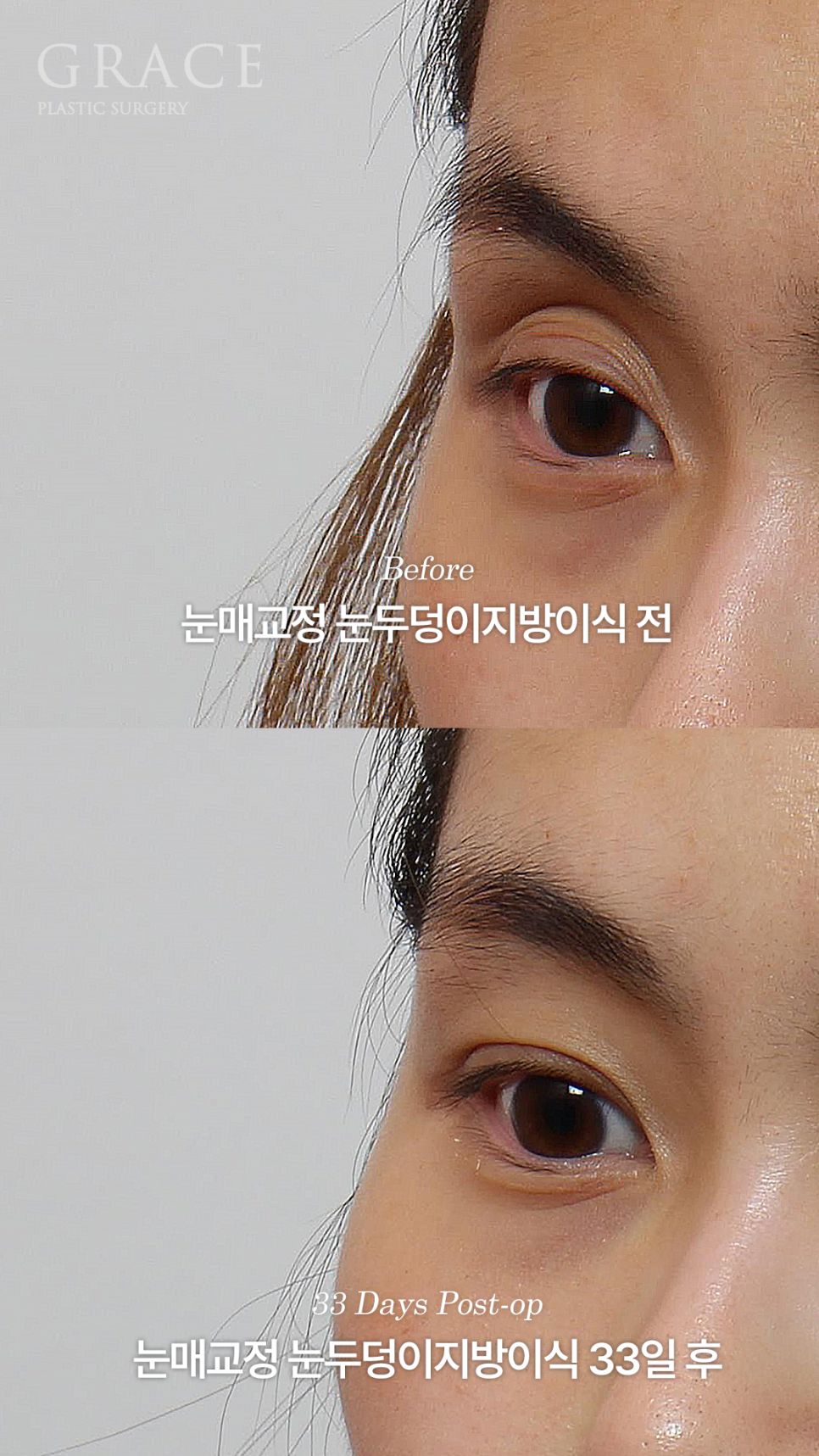 눈매교정 망하고 눈재수술 &middot; 눈두덩이 안와지방이식 관련 이미지 5