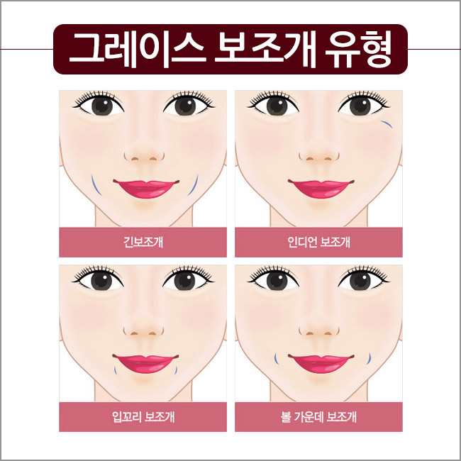 핫한 보조개수술, 신사역 그레이스성형외과에서 관련 이미지 3