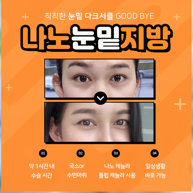 다크써클수술가격 눈밑이 밝아져요 관련 이미지 3