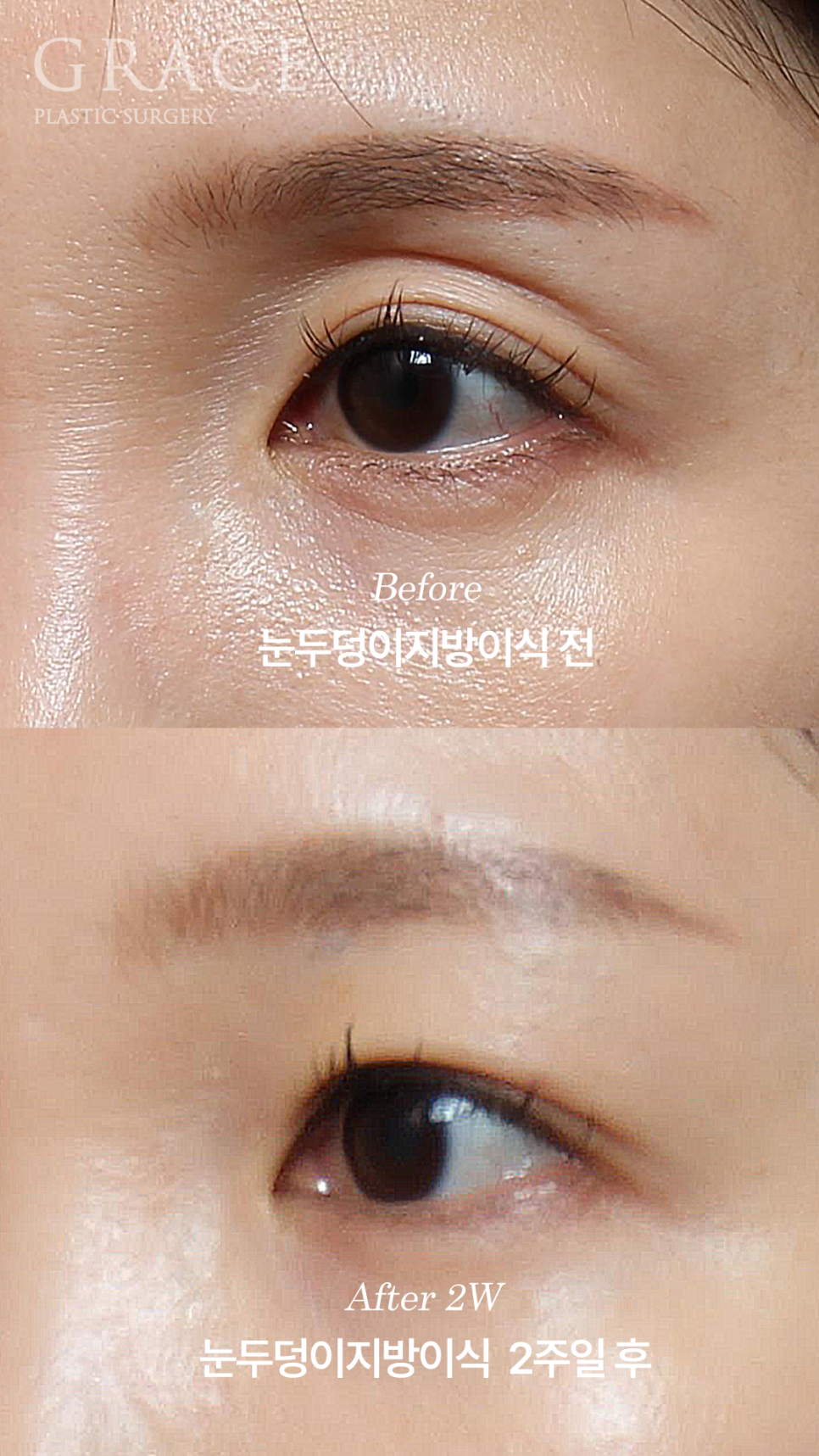 Double Eyelid Fat Grafting Fails When It Becomes Visible and Bumpy? image 3