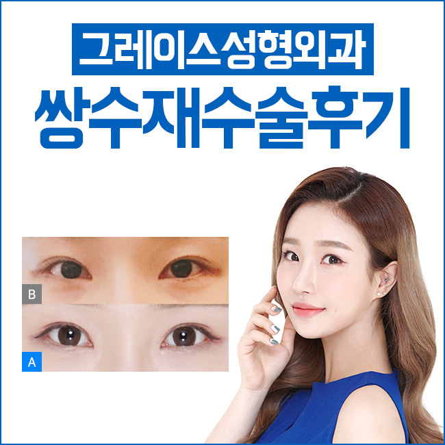 쌍수재수술후기 만족스러운 결과를 위한 선택 관련 이미지 2