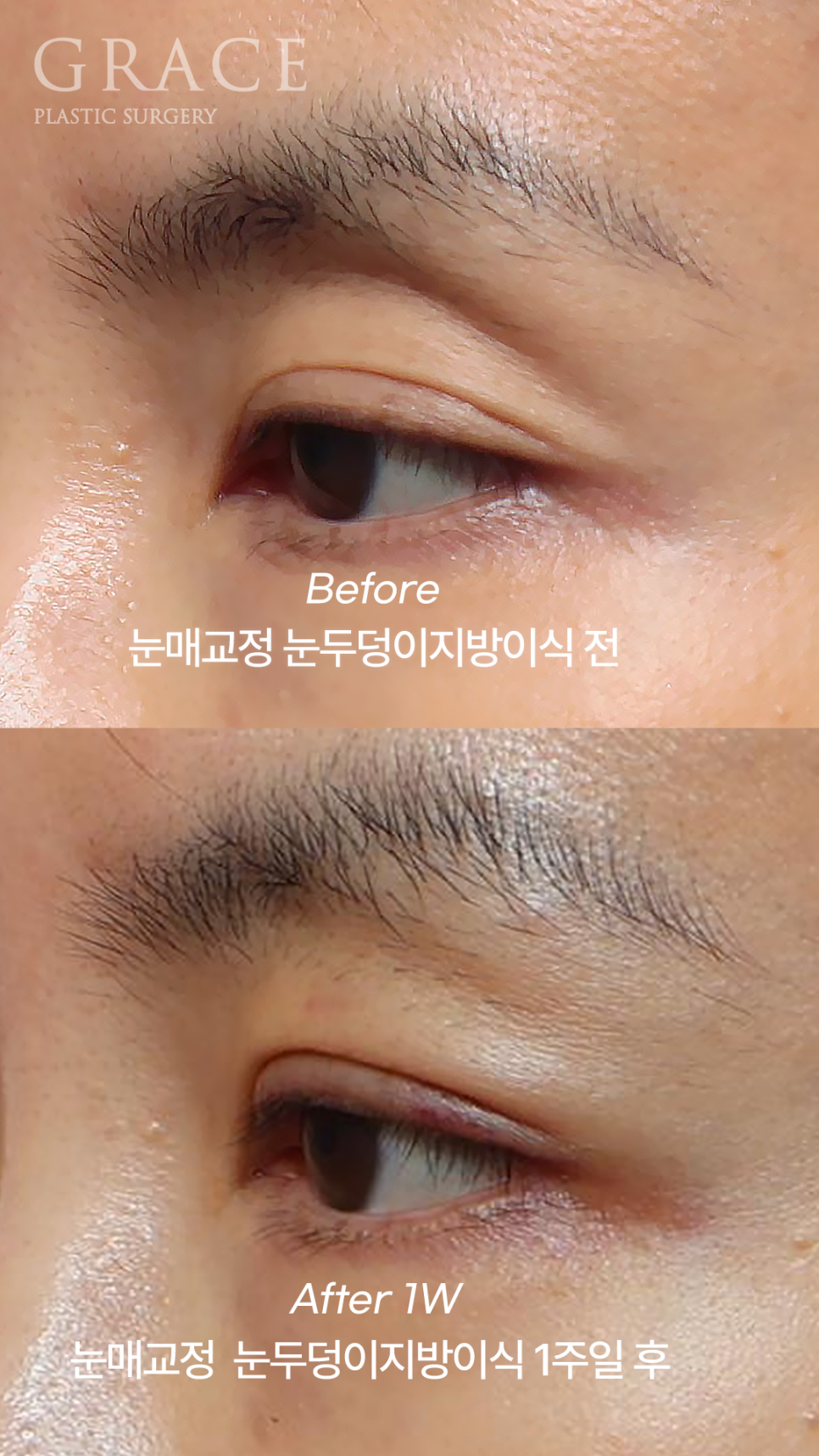 Why Eyelid Hollow Fat Grafting and Orbital Fat Injection Are Important: From Duration of Results to How to Prevent Bumpy Side Effects image 5