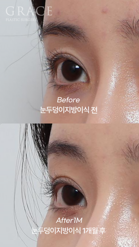 For Those Saddened by Sunken Eyelids (Upper-Eyelid Fat Grafting) image 9