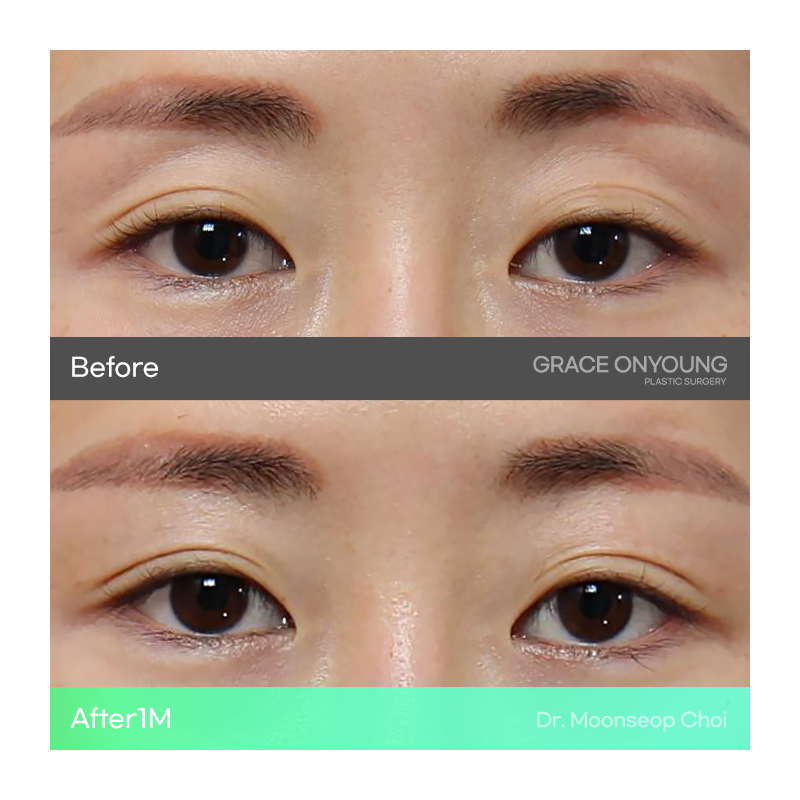 Shocked After Hearing That My Hollow Eyes and Sunken Eye Holes Were Severe? Upper Eyelid Fat Grafting image 8