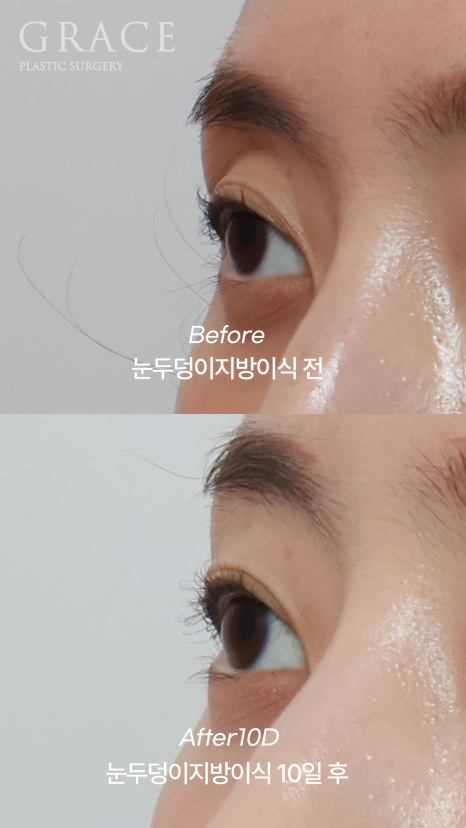 눈꺼풀 지방이식 수술 After l 30대 후반 10일 차 붓기와 생착률 관련 이미지 5