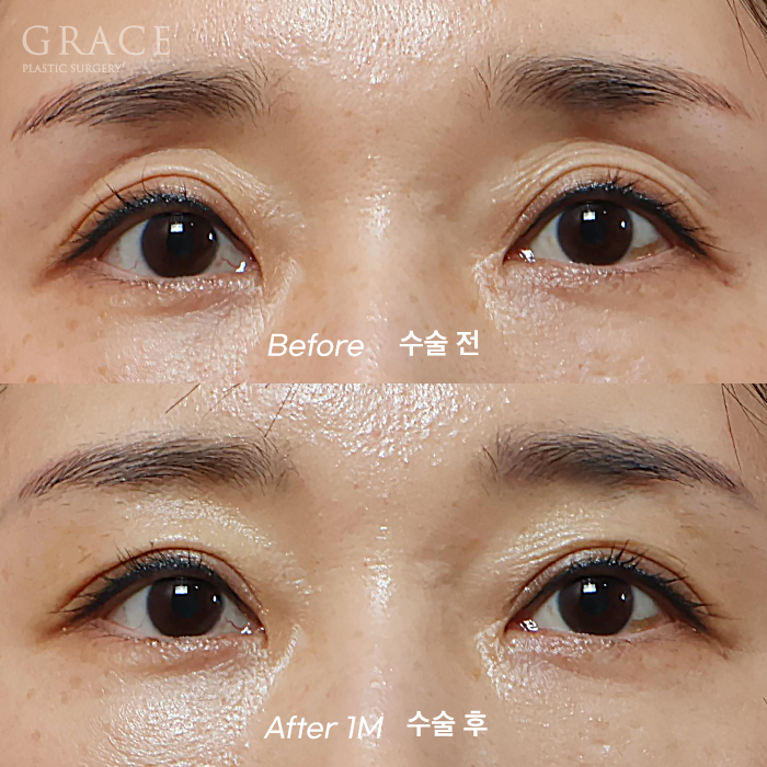 Eyelid Fat Grafting Side Effects? How to Settle In Beautifully Without Lumps image 1