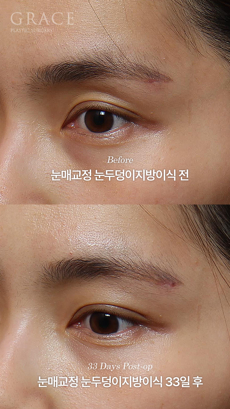 눈매교정 망하고 눈재수술 &middot; 눈두덩이 안와지방이식 관련 이미지 4