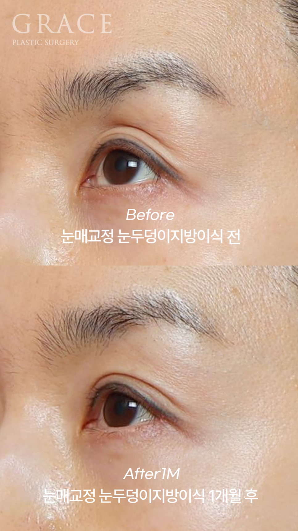 Sunken Upper Eyelids: Fillers or Fat Grafting? image 3