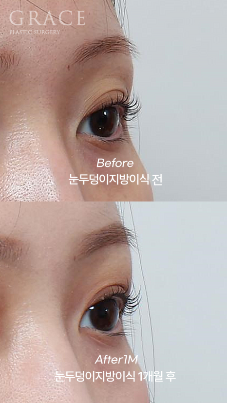 Upper Eyelid Fat Grafting Before and After in a Person in Their Late 50s and a Person in Their Late 20s image 1
