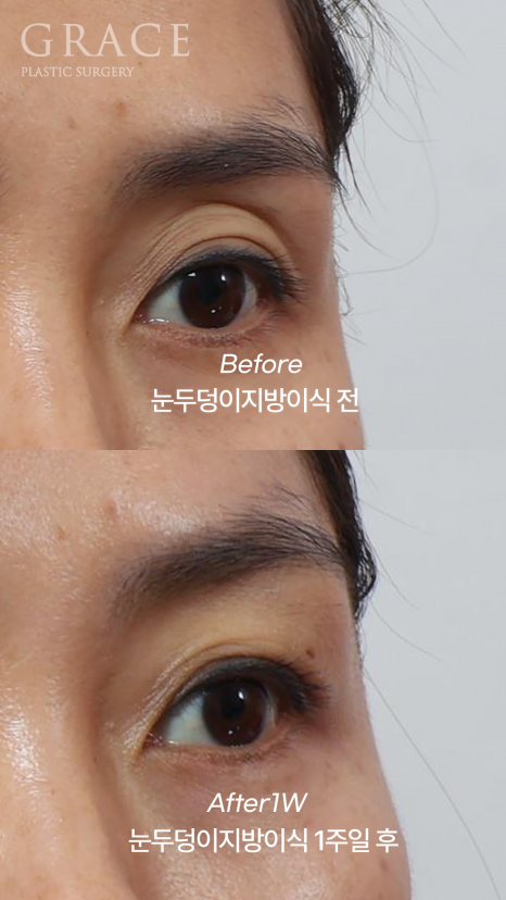 Sagging Eye Hollows and Sunken Eyelid Fat Grafting: Reasonable Cost (Price) Information and image 6