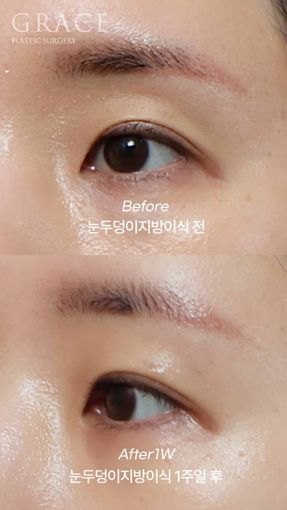 눈두덩이 지방이식 1주일 차 자연스러운 회복 중 관련 이미지 1
