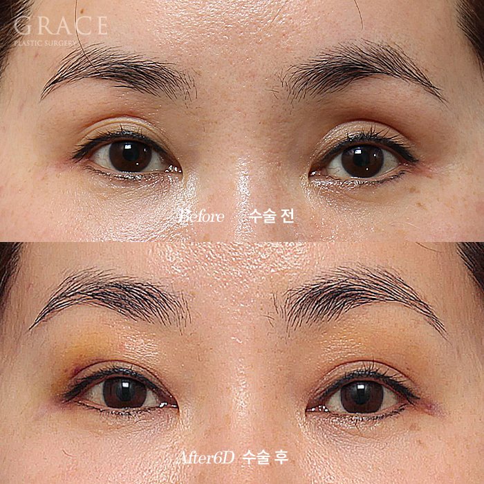 Why It’s Not Always Better Just Because Lower Eyelid Fat Grafting Is Cheap image 7