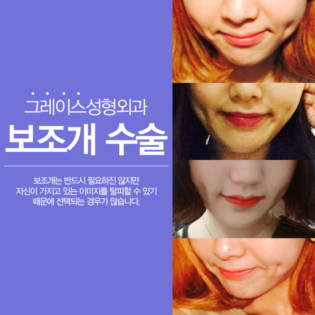 그레이스성형외과 김윤호원장님의 보조개수술 관련 이미지 1