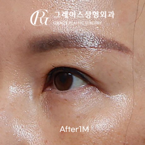 A Complete Guide to the Best Combination of Midlife Eye Surgery, from Under-Eye Fat Repositioning Costs to an I-Hole Filler Alternative image 3