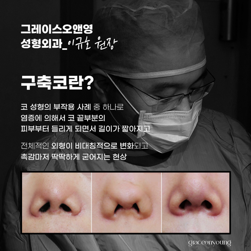코재수술 구축코 들창코 사례와 비공내리기 관련 이미지 2