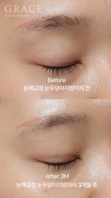 30대 눈꺼풀 꺼짐 교정 눈두덩이지방이식과 비절개눈매교정으로 자연스럽게 복원된 눈매 관련 이미지 3