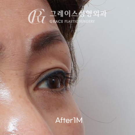 60대 눈꺼풀 고민 상안검 대신 선택한 눈두덩이 지방이식 관련 이미지 4