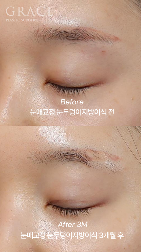 30대 눈꺼풀 꺼짐 교정 눈두덩이지방이식과 비절개눈매교정으로 자연스럽게 복원된 눈매 관련 이미지 6