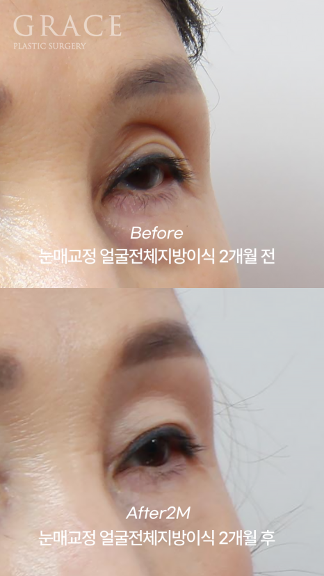 In Your 50s, Restoring a Youthful Look with Before-and-After Eye Surgery and Fat Grafting to the Upper Eyelids, Temples, Under-Eyes, and Above the Brows image 3