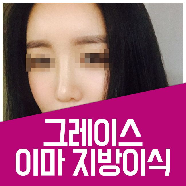 어느 각도에서도 예쁜 볼륨감! 이마지방이식 관련 이미지 4