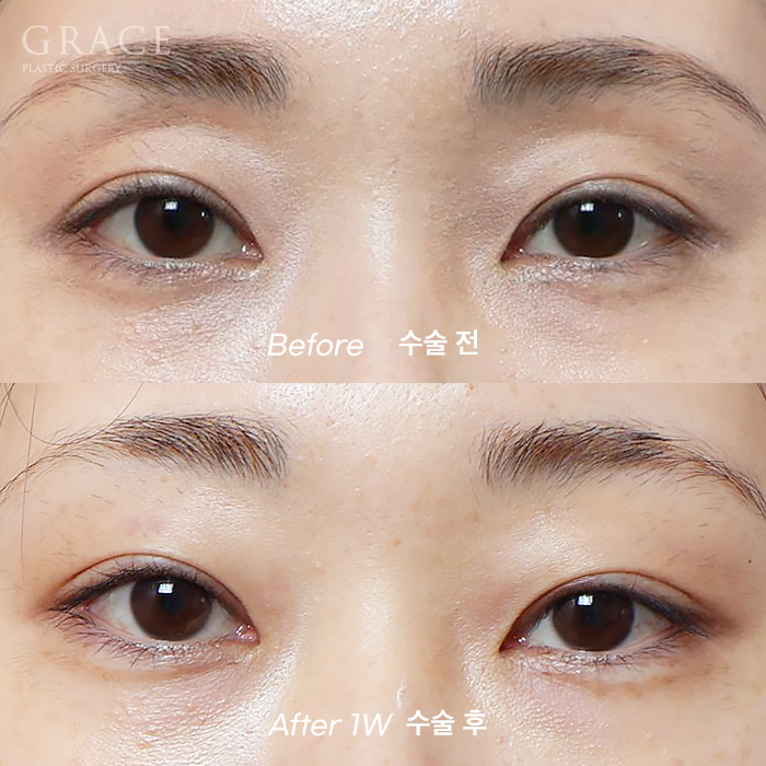 How to Fill Sunken Eyelid Hollows with Fat Grafting (Concerns About Filler Side Effects) image 7
