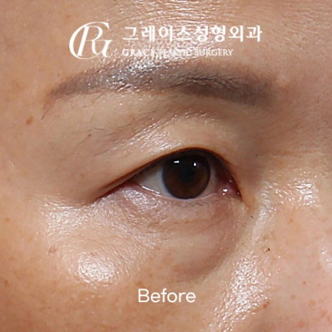 A Complete Guide to the Best Combination of Midlife Eye Surgery, from Under-Eye Fat Repositioning Costs to an I-Hole Filler Alternative image 7