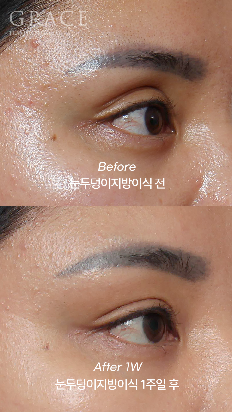 눈꺼풀 지방이식 부작용 왜 생기는지 아시나요? 관련 이미지 8