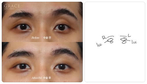 Complications from Sunken Eyelid Fat Grafting? The Injection Location Determines the Result image 5