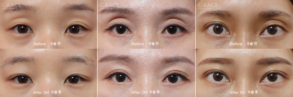 눈두덩이 지방이식 유지기간&middot;부작용&middot;정확한 시술 총정리 관련 이미지 3