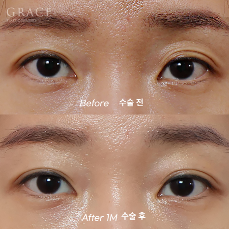 …The Result of Eyelid Fat Grafting (If You’re Worried About Side Effects and Swelling) image 1