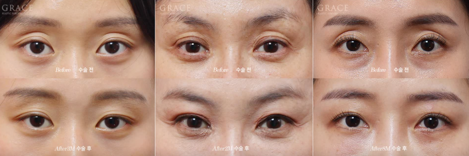 꺼진 아이홀 지방이식 유지기간과 부작용까지 알고 결정해야 하는 이유 관련 이미지 3
