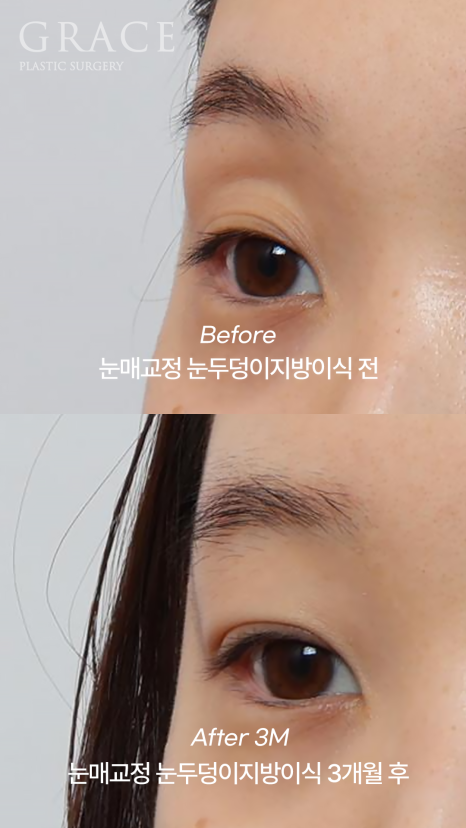 30대 눈꺼풀 꺼짐 교정 눈두덩이지방이식과 비절개눈매교정으로 자연스럽게 복원된 눈매 관련 이미지 8