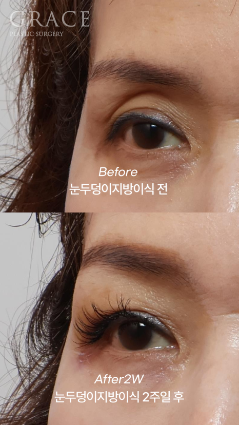 Concerns About Swelling and Side Effects After “Eye Hollow Fat Grafting” Surgery in the Eye Socket Area for People in Their 60s image 8