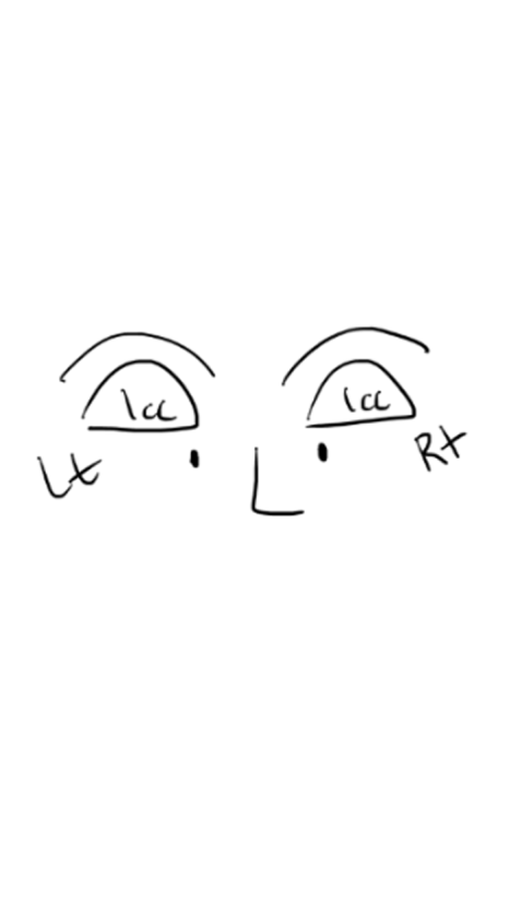 60대 중년 눈두덩이 안와지방이식 1cc 전후 관련 이미지 2