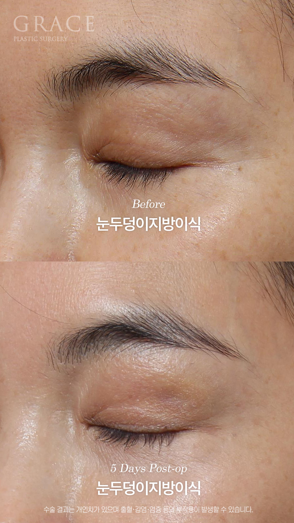 Will a Sunken Upper Eyelid Become Bumpy When You Close Your Eyes After Fat Grafting? image 3