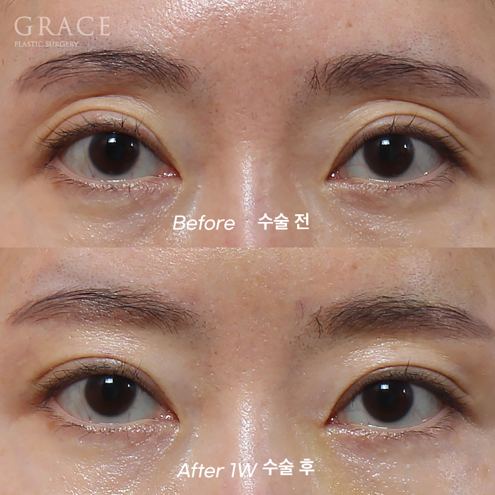 눈두덩이 지방이식 or 풀페이스 지방이식 유지기간&middot;부작용까지 정리 관련 이미지 1