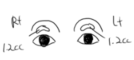 Upper Eyelid Fat Grafting, Yellow Bruising and Swelling (... Changes Noted After 5 Days) image 2
