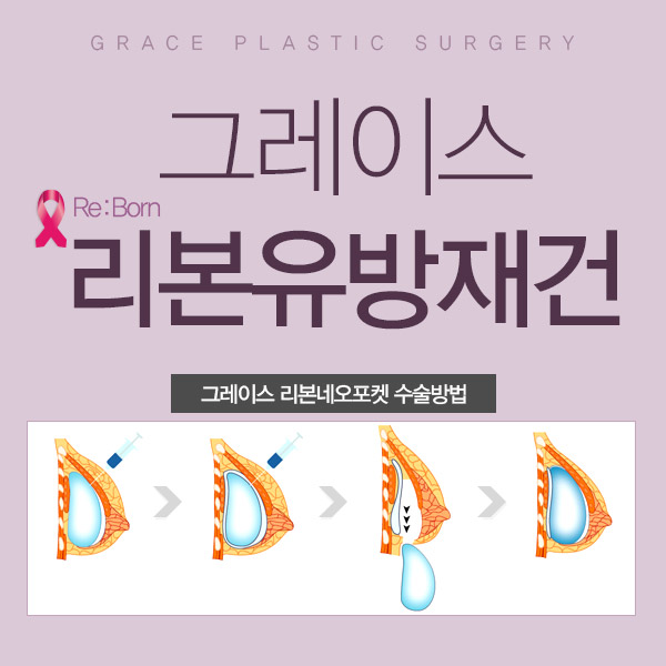 유방암 수술 후 유방재건술, 그레이스성형외과 최문섭원장님에게 관련 이미지 3