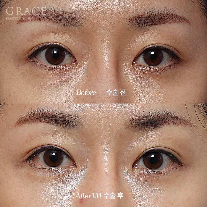 Upper Eyelid Fat Grafting Side Effects? The Difference in Survival Rates Between Frozen Fat and Fresh Fat image 2