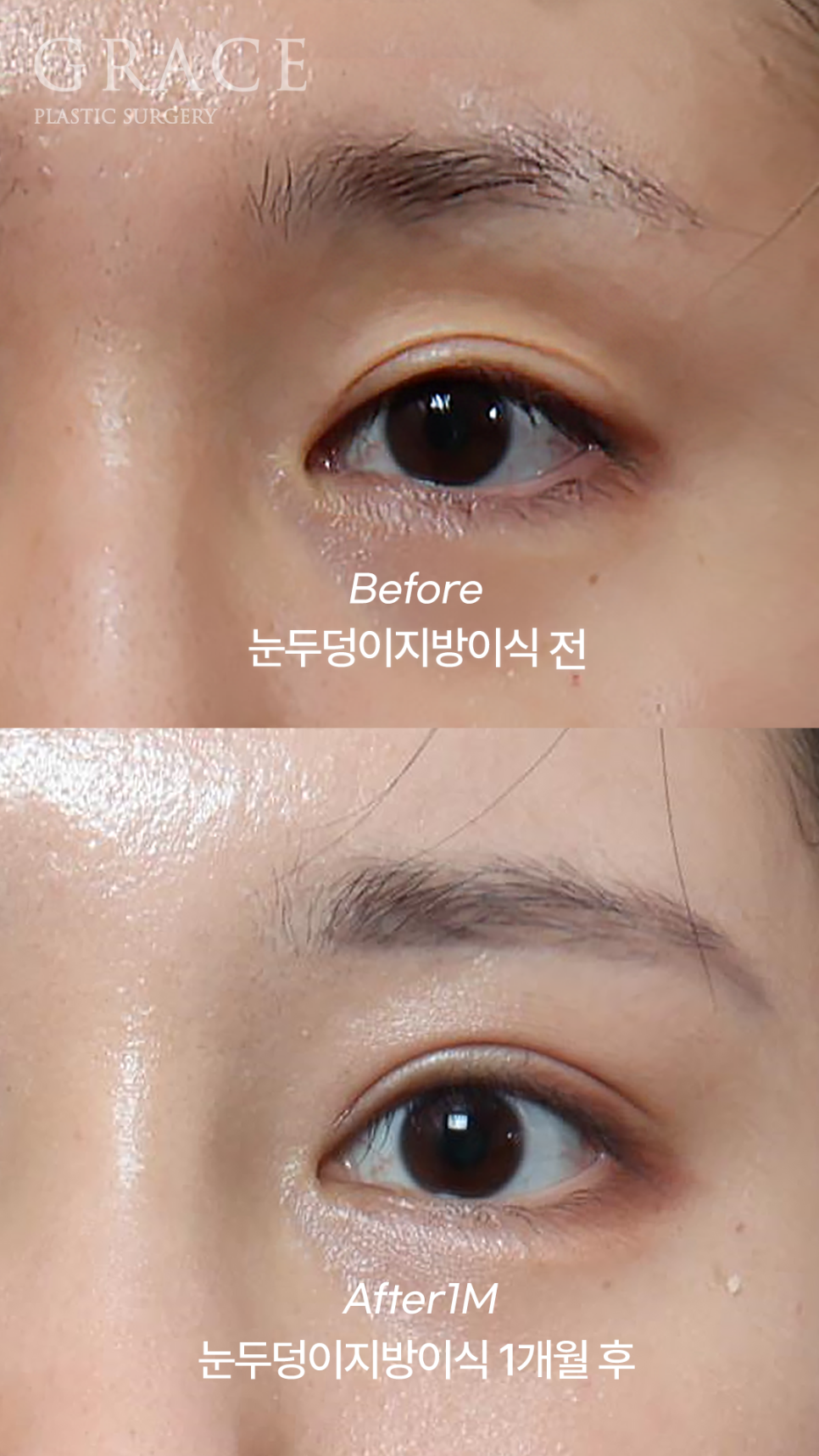 20대 후반 절개눈매교정+눈꺼풀지방이식 관련 이미지 2