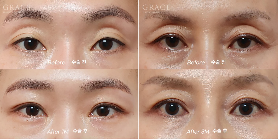 Why Do Hollow Eyelids Occur, and How Can They Be Naturally Improved? (Research Notes from a Doctor Performing Eyelid Fat Grafting) image 12