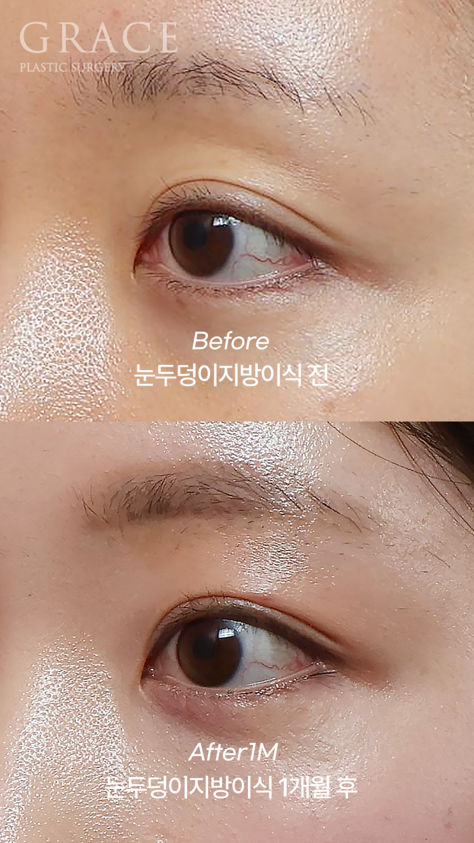 Why Eyelid Hollow Fat Grafting and Orbital Fat Injection Are Important: From Duration of Results to How to Prevent Bumpy Side Effects image 10