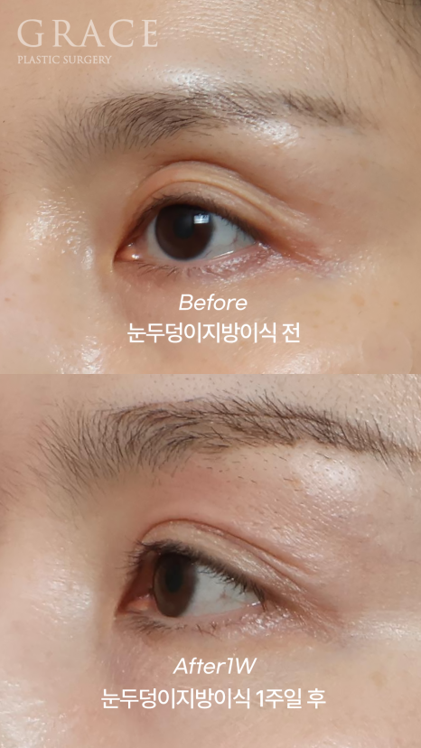 안와지방이식 꺼진 눈매를 되살리는 아이홀 꺼짐 솔루션 관련 이미지 3
