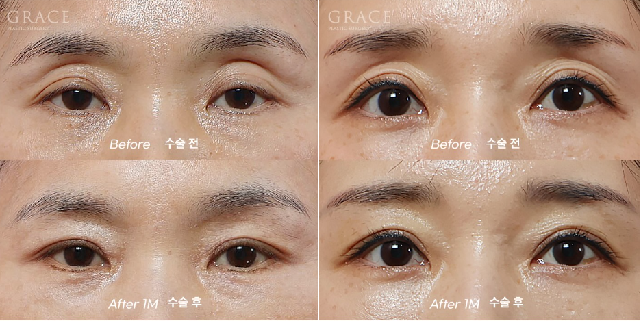 The Basis for a 94.5% Functional Improvement: Fat Grafting Technology That Fills in a Sunken Eye Hollow image 6